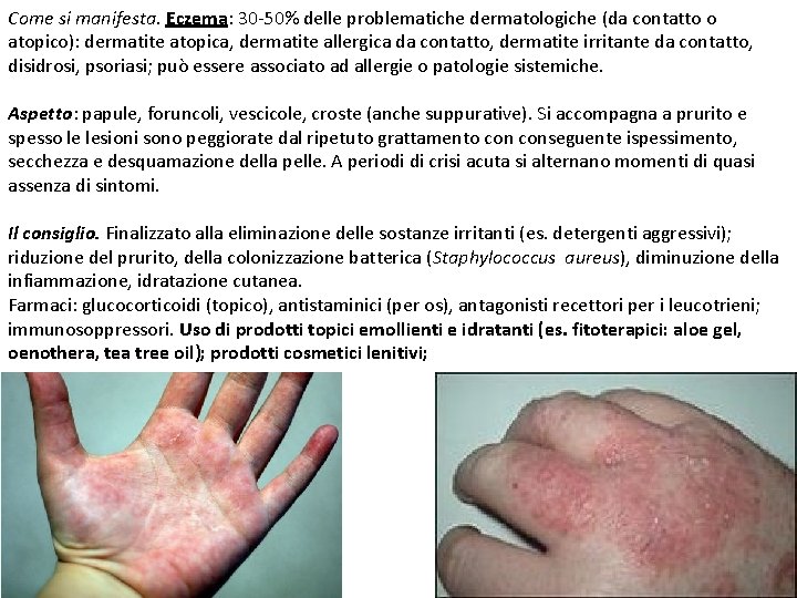 Come si manifesta. Eczema: 30 -50% delle problematiche dermatologiche (da contatto o atopico): dermatite
