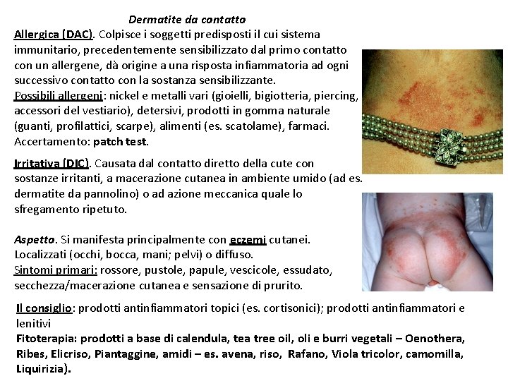 Dermatite da contatto Allergica (DAC). Colpisce i soggetti predisposti il cui sistema immunitario, precedentemente
