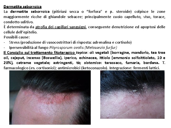Dermatite seborroica La dermatite seborroica (pitiriasi secca o “forfora” e p. steroide) colpisce le