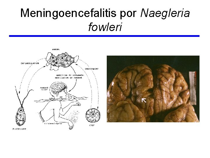Meningoencefalitis por Naegleria fowleri 