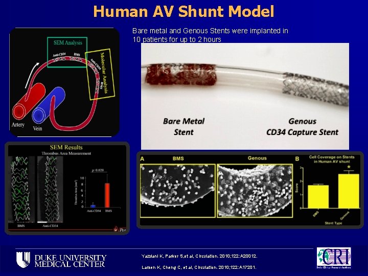 Human AV Shunt Model Bare metal and Genous Stents were implanted in 10 patients