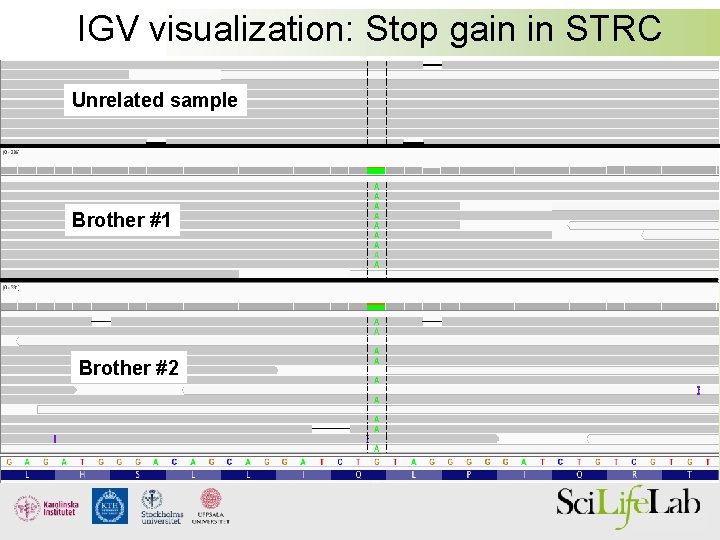 IGV visualization: Stop gain in STRC Unrelated sample Brother #1 Brother #2 