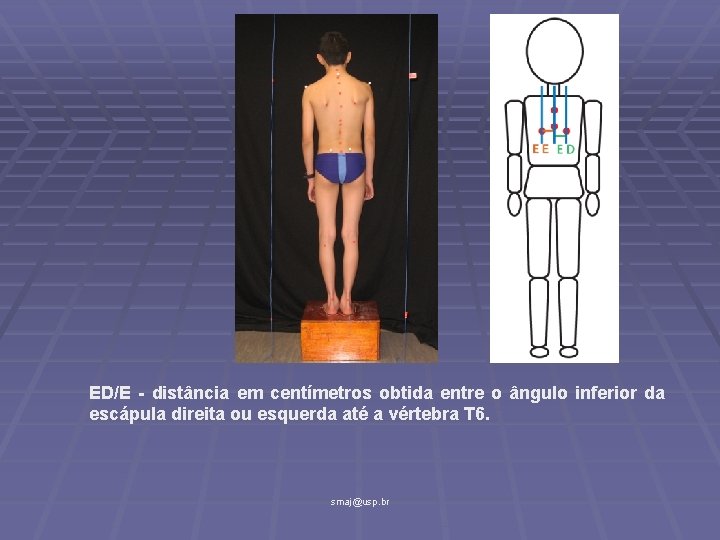 ED/E - distância em centímetros obtida entre o ângulo inferior da escápula direita ou
