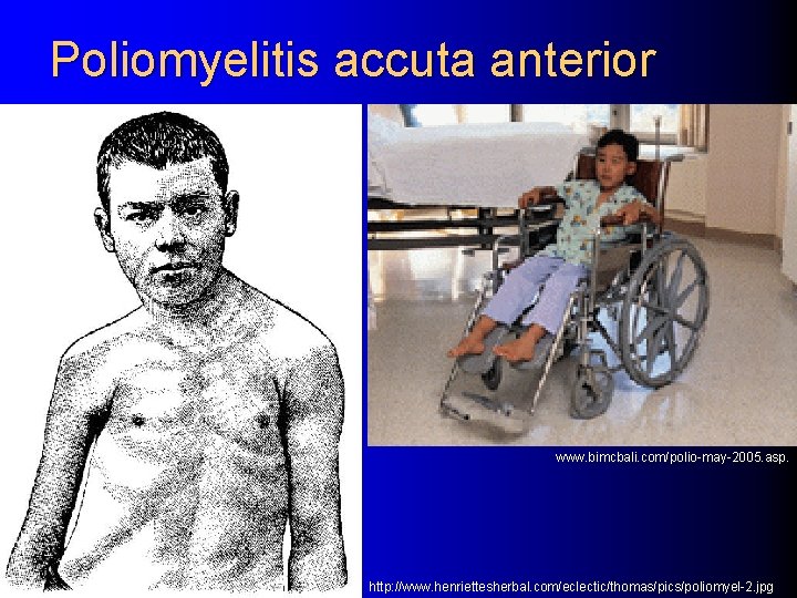 Poliomyelitis accuta anterior www. bimcbali. com/polio-may-2005. asp. http: //www. henriettesherbal. com/eclectic/thomas/pics/poliomyel-2. jpg 
