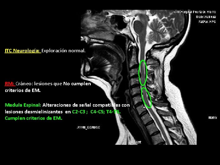 ITC Neurología: Exploración normal. RM: Cráneo: lesiones que No cumplen criterios de EM. Medula