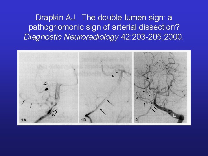 Drapkin AJ. The double lumen sign: a pathognomonic sign of arterial dissection? Diagnostic Neuroradiology