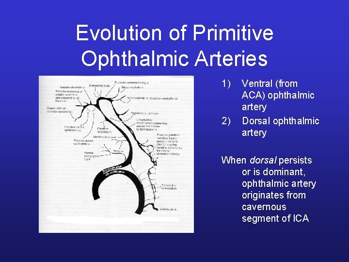 Evolution of Primitive Ophthalmic Arteries 1) 2) Ventral (from ACA) ophthalmic artery Dorsal ophthalmic