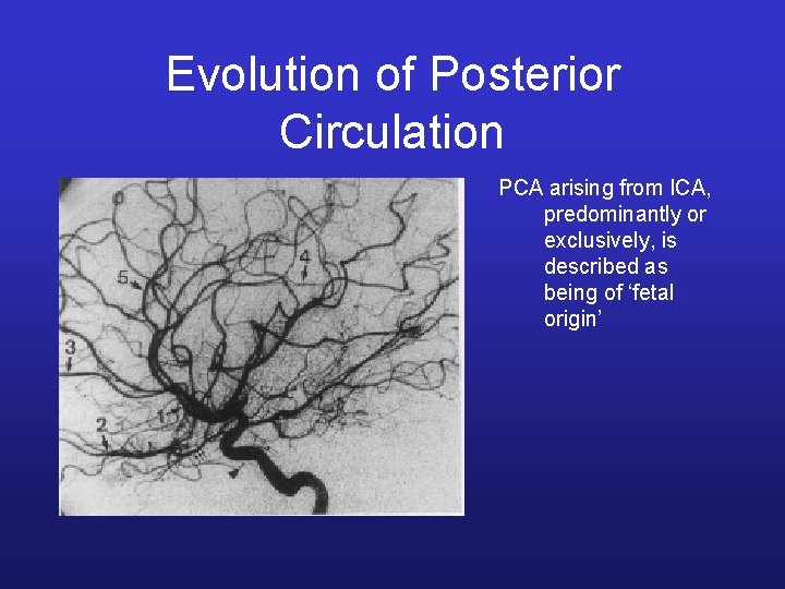 Evolution of Posterior Circulation PCA arising from ICA, predominantly or exclusively, is described as