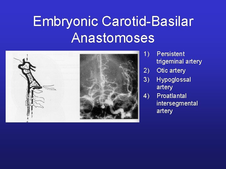 Embryonic Carotid-Basilar Anastomoses 1) 2) 3) 4) Persistent trigeminal artery Otic artery Hypoglossal artery