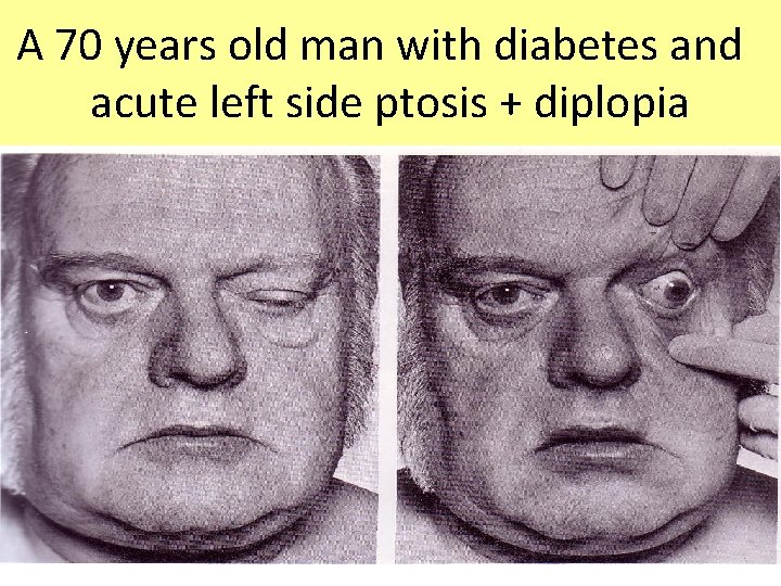A 70 years old man with diabetes and acute left side ptosis + diplopia