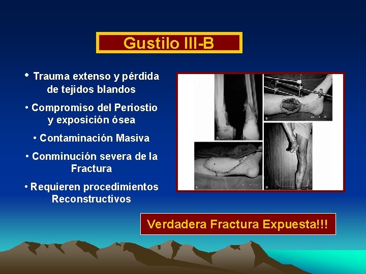 Gustilo III-B • Trauma extenso y pérdida de tejidos blandos • Compromiso del Periostio