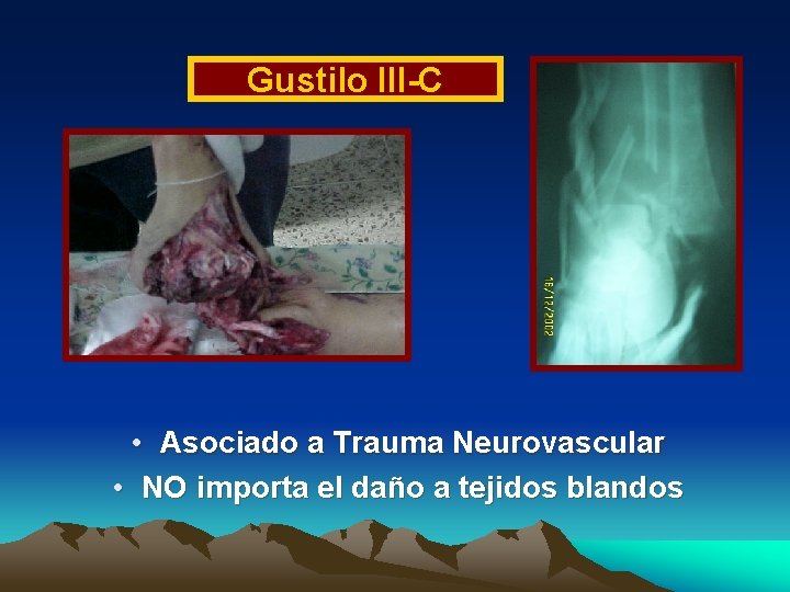 Gustilo III-C • Asociado a Trauma Neurovascular • NO importa el daño a tejidos