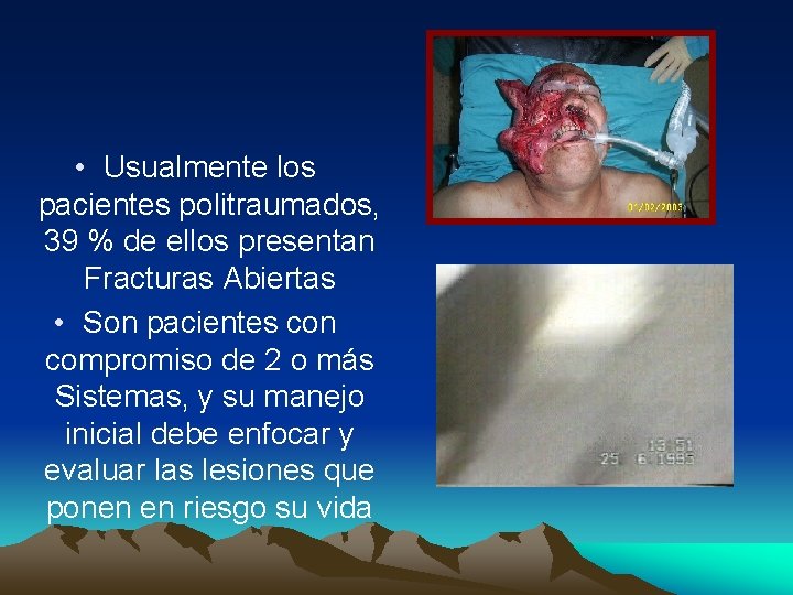  • Usualmente los pacientes politraumados, 39 % de ellos presentan Fracturas Abiertas •