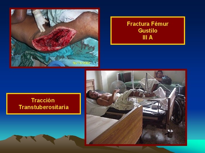 Fractura Fémur Gustilo III A Tracción Transtuberositaria 