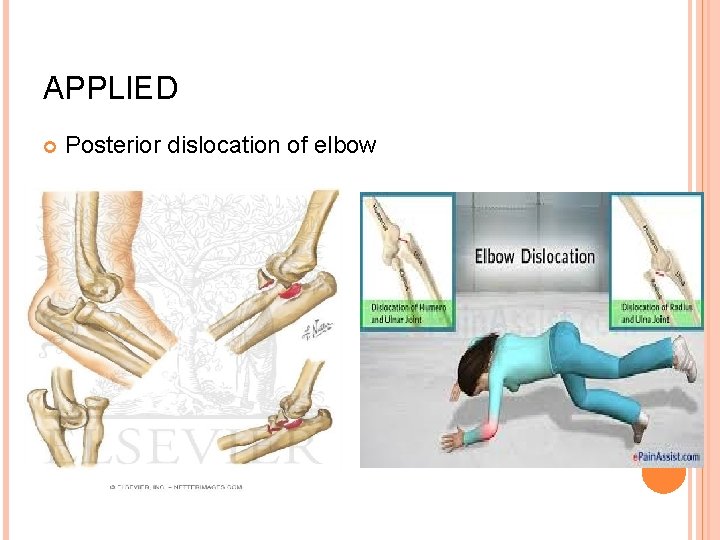 APPLIED Posterior dislocation of elbow 