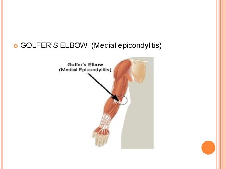  GOLFER’S ELBOW (Medial epicondylitis) 