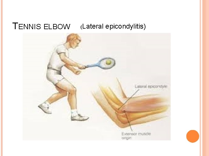 TENNIS ELBOW (Lateral epicondylitis) 