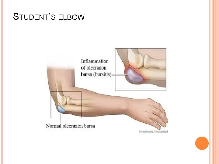 STUDENT’S ELBOW 