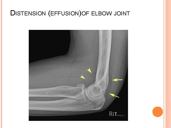 DISTENSION (EFFUSION)OF ELBOW JOINT 