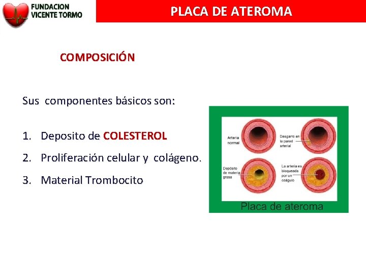 PLACA DE ATEROMA COMPOSICIÓN Sus componentes básicos son: 1. Deposito de COLESTEROL 2. Proliferación