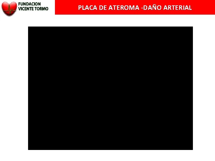 PLACA DE ATEROMA -DAÑO ARTERIAL 