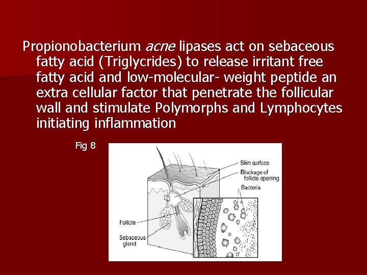 Propionobacterium acne lipases act on sebaceous fatty acid (Triglycrides) to release irritant free fatty