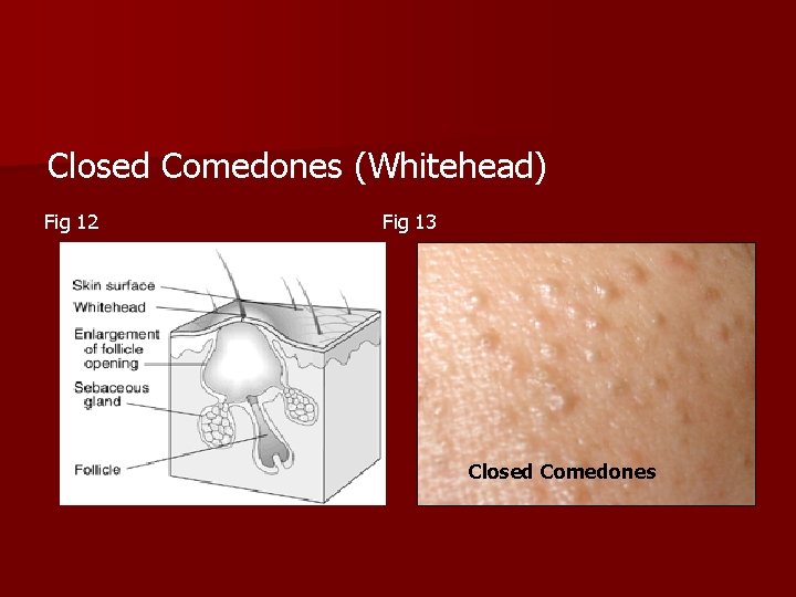 Closed Comedones (Whitehead) Fig 12 Fig 13 Closed Comedones 