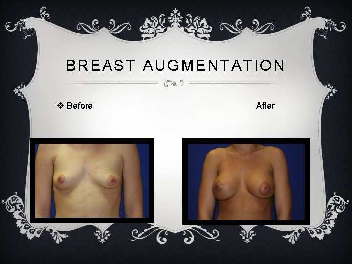BREAST AUGMENTATION v Before After 