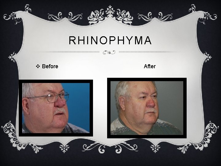 RHINOPHYMA v Before After 