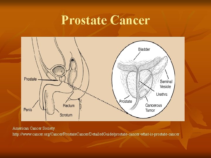 Prostate Cancer American Cancer Society http: //www. cancer. org/Cancer/Prostate. Cancer/Detailed. Guide/prostate-cancer-what-is-prostate-cancer 