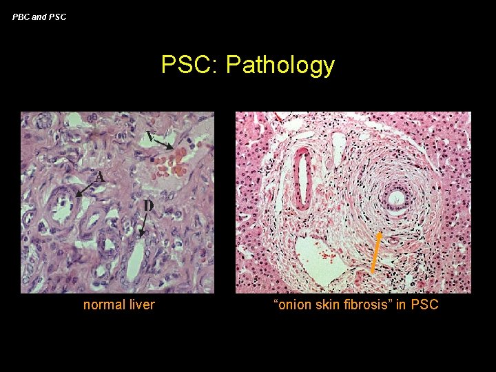 PBC and PSC: Pathology normal liver “onion skin fibrosis” in PSC 