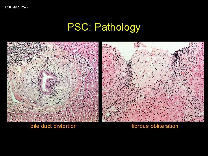 PBC and PSC: Pathology bile duct distortion fibrous obliteration 