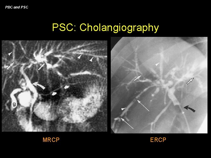 PBC and PSC: Cholangiography MRCP ERCP 