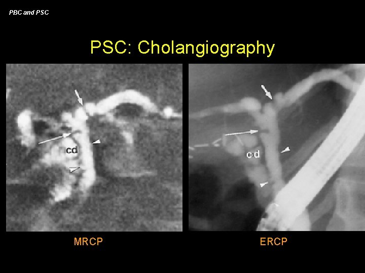 PBC and PSC: Cholangiography MRCP ERCP 