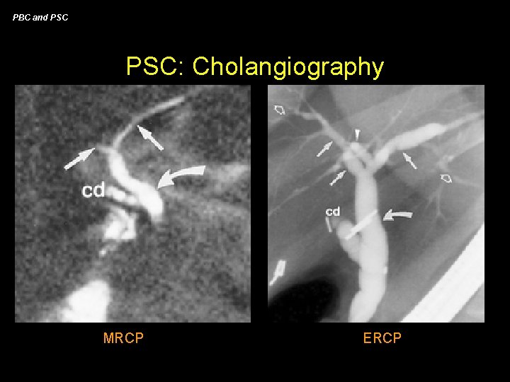 PBC and PSC: Cholangiography MRCP ERCP 