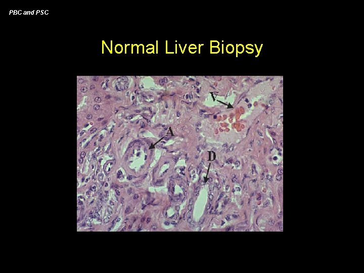 PBC and PSC Normal Liver Biopsy 