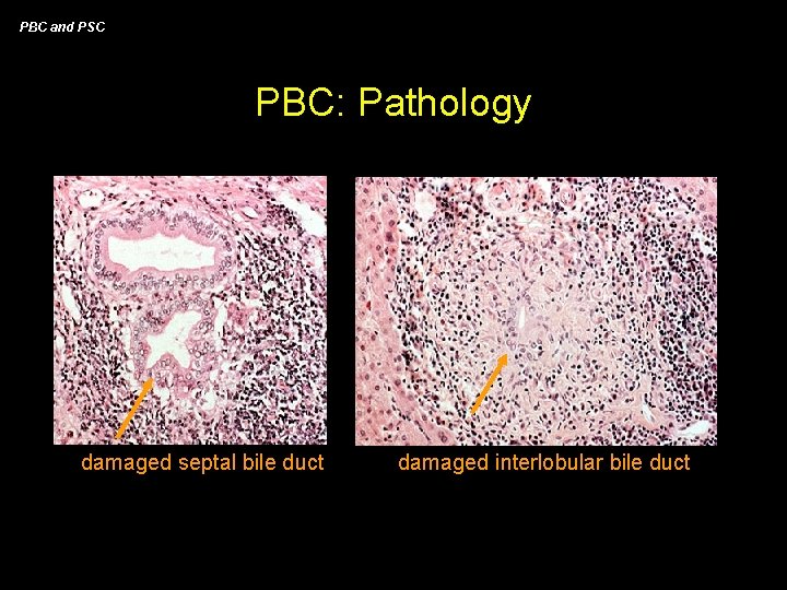 PBC and PSC PBC: Pathology damaged septal bile duct damaged interlobular bile duct 