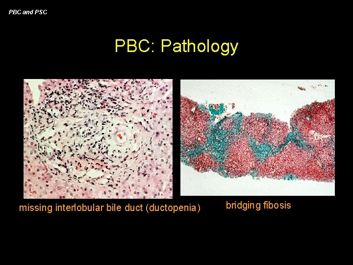 PBC and PSC PBC: Pathology missing interlobular bile duct (ductopenia) bridging fibosis 