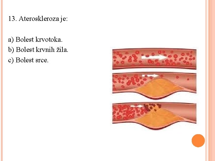 13. Ateroskleroza je: a) Bolest krvotoka. b) Bolest krvnih žila. c) Bolest srce. 