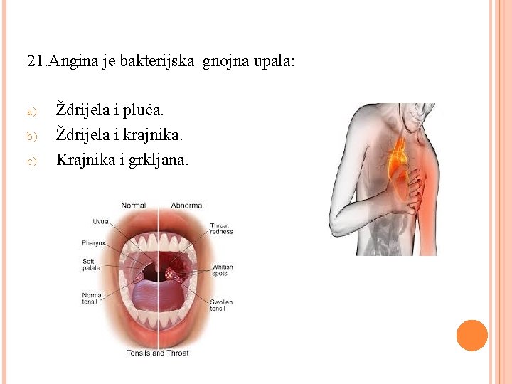 21. Angina je bakterijska gnojna upala: a) b) c) Ždrijela i pluća. Ždrijela i