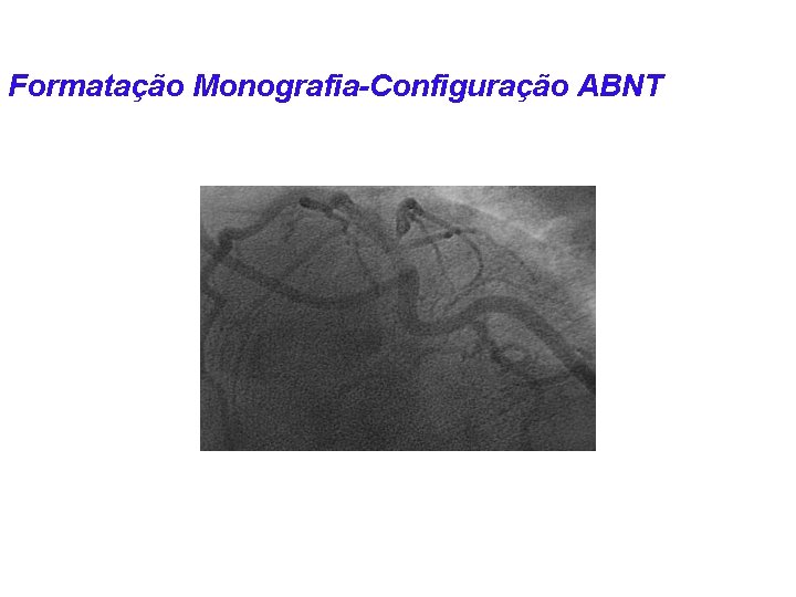 Formatação Monografia-Configuração ABNT Figuras: Exemplo Figura 5. 3 Imagem cardíaca de angiografia, aspecto normal.