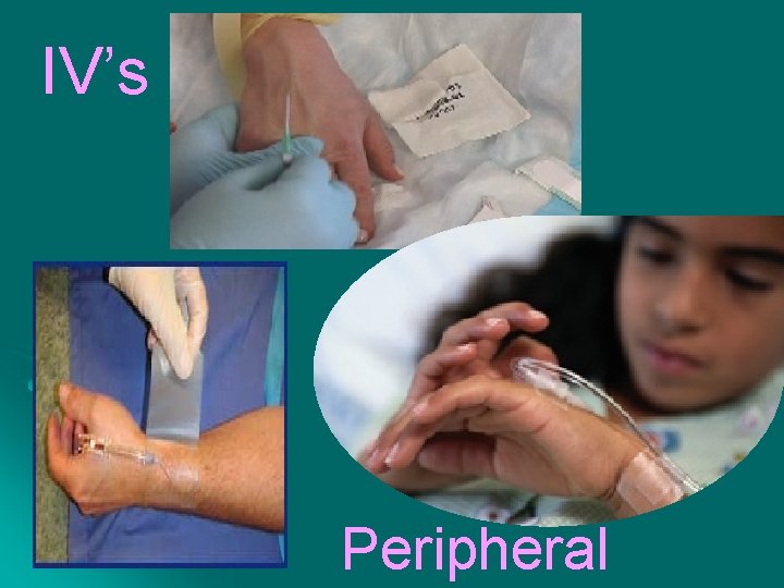 IV’s Peripheral 
