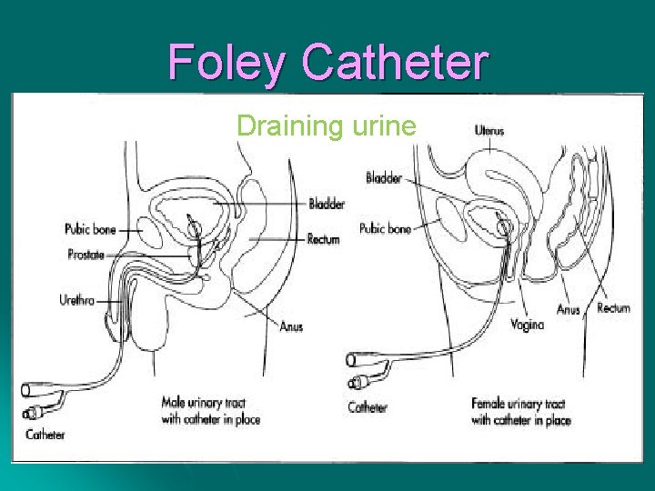 Foley Catheter Draining urine 