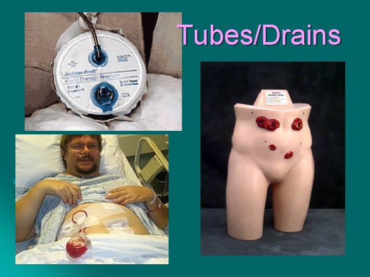 Tubes/Drains 