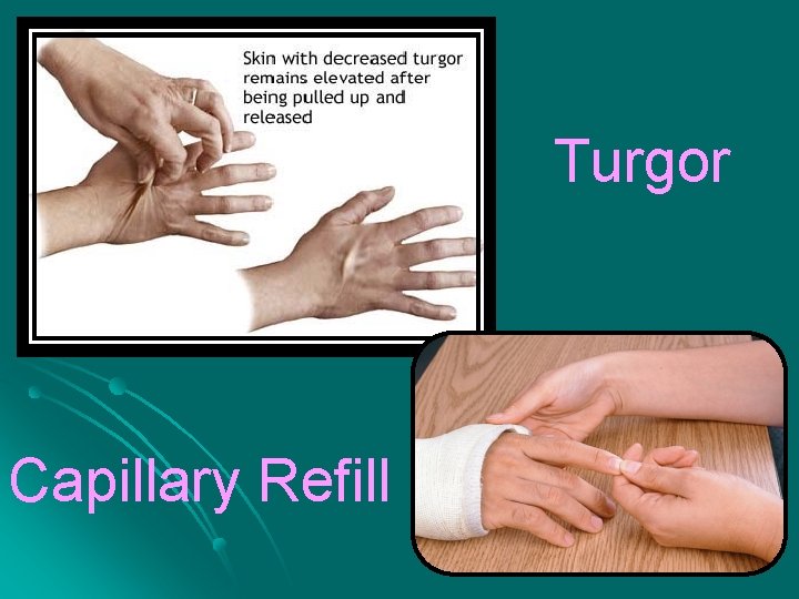 Turgor Capillary Refill 