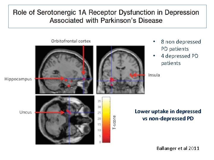  • 8 non depressed PD patients • 4 depressed PD patients Lower uptake