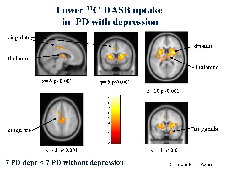 Lower 11 C-DASB uptake in PD with depression cingulate striatum thalamus x= 6 p<0.