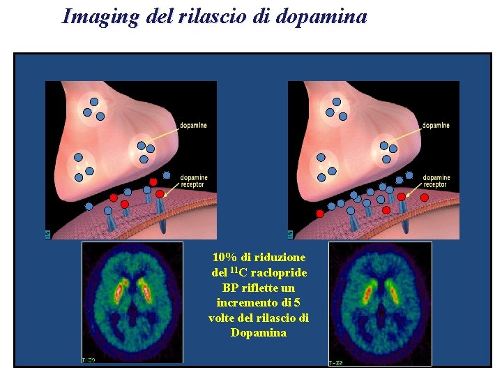Imaging del rilascio di dopamina 10% di riduzione del 11 C raclopride BP riflette