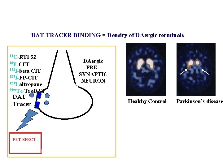 DAT TRACER BINDING = Density of DAergic terminals 11 C-RTI 32 DAergic PRE SYNAPTIC