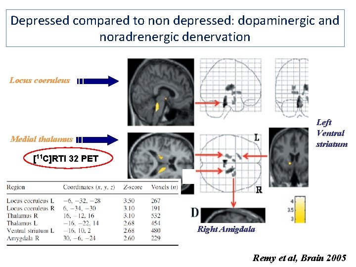 Depressed compared to non depressed: dopaminergic and noradrenergic denervation Locus coeruleus Left Ventral striatum